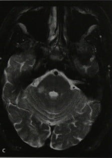 Снимки МРТ и КТ. Расслоение позвоночной артерии