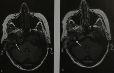 Снимки МРТ и КТ. Опухоль барабанного гломуса