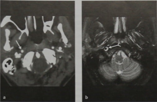 Снимки МРТ и КТ. Расслоение внутренней сонной артерии