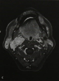 Снимки МРТ и КТ. Опухоль каротидного гломуса