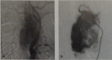 Снимки МРТ и КТ. Опухоль каротидного гломуса