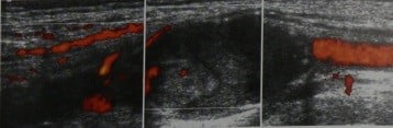 Снимки МРТ и КТ. Аневризмы периферических артерий
