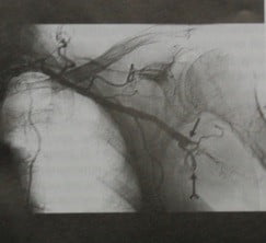 Снимки МРТ и КТ. Эмболическая окклюзия артерии