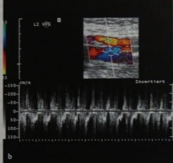 Снимки МРТ и КТ. Артериовенозная фистула после пункции артерии