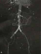 Снимки МРТ и КТ. Окклюзирующие заболевания периферических артерий