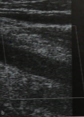 Снимки МРТ и КТ. Тромбоз глубоких вен малого таза и нижних конечнос