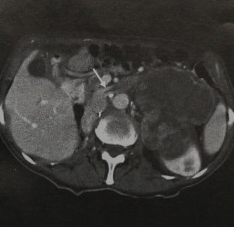 Снимки МРТ и КТ. Опухолевая инфильтрация почечной вены