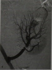 Снимки МРТ и КТ. Посттрансплантационный стеноз почечной артерии