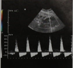 Снимки МРТ и КТ. Посттрансплантационный тромбоз почечной вены