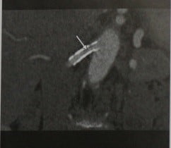Снимки МРТ и КТ. Рестеноз почечной артерии после стентирования