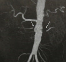 Снимки МРТ и КТ. Стеноз почечной артерии 