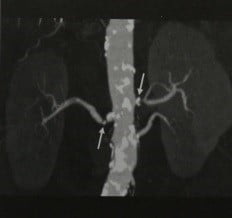 Снимки МРТ и КТ. Стеноз почечной артерии 