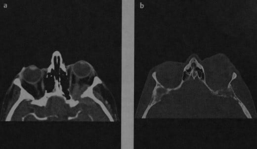 Снимки МРТ и КТ. Метастазы в верхушку глазницы