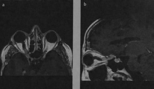 Снимки МРТ и КТ. Менингиома зрительного нерва