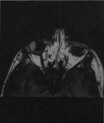 Снимки МРТ и КТ. Меланома сетчатки