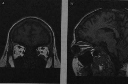 Снимки МРТ и КТ. Эндокринная офтальмопатия