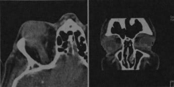 Снимки МРТ и КТ. Лимфома глазницы