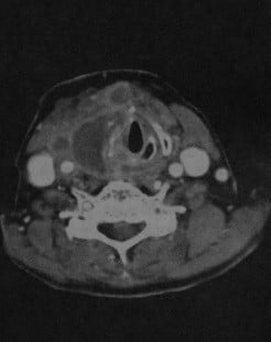 Снимки МРТ и КТ. Окологлоточный абсцесс - парафарингеальный абсцесс