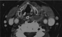 Снимки МРТ и КТ. Перелом щитовидного хряща