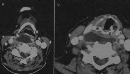 Снимки МРТ и КТ. Предпозвоночный абсцесс шейного отдела позвоночник