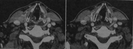 Снимки МРТ и КТ. Рак надскладочного отдела гортани