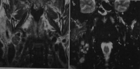 Снимки МРТ и КТ. Метастазы в лимфоузлах