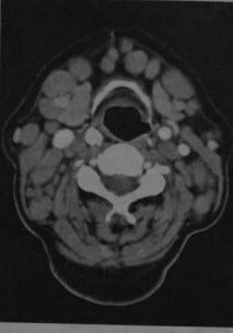 Снимки МРТ и КТ. Лимфома лимфатических узлов