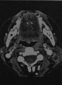 Снимки МРТ и КТ. Шейный лимфаденит у взрослых