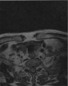 Снимки МРТ и КТ. Аденома паращитовидной железы
