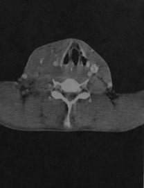 Снимки МРТ и КТ. Гематома шеи