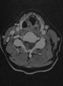 Снимки МРТ и КТ. Тромбоз яремной вены на шее