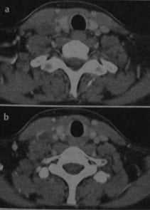 Снимки МРТ и КТ. Тромбоз яремной вены на шее