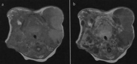 Снимки МРТ и КТ. Лимфогенная киста шеи