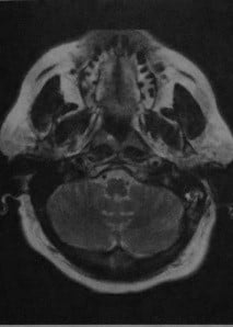 Снимки МРТ и КТ. Аневризма, расслоение внутренней сонной артерии