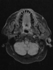 Снимки МРТ и КТ. Аневризма, расслоение внутренней сонной артерии