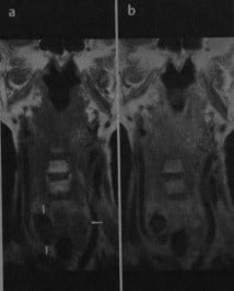 Снимки МРТ и КТ. Зоб (многоузловой, диффузный)