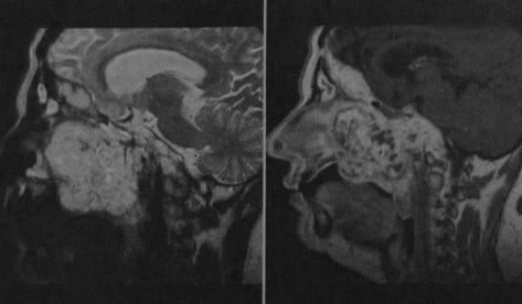 Снимки МРТ и КТ. Хордома ската черепа