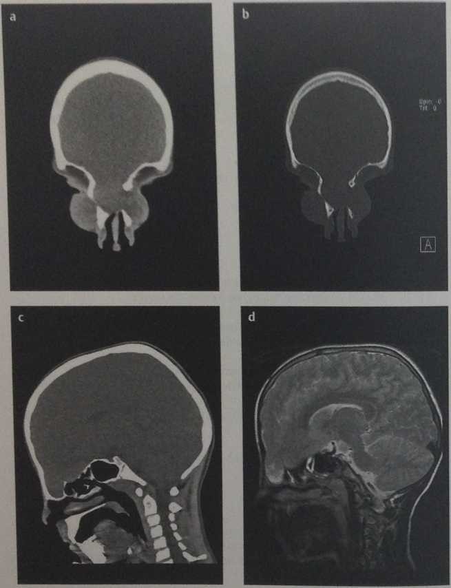 Снимки МРТ и КТ. Энцефалоцеле основания черепа