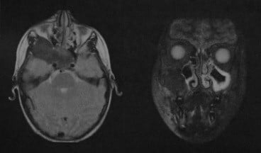 Снимки МРТ и КТ. Фиброзная остеодисплазия