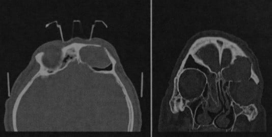 Снимки МРТ и КТ. Мукоцеле придаточных пазух носа