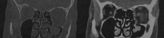 Снимки МРТ и КТ. Переломы костей средней зоны лица