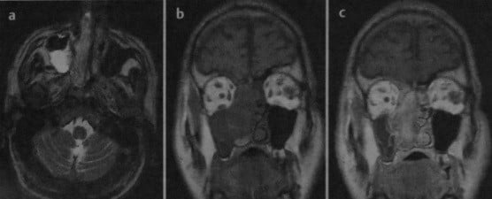 Снимки МРТ и КТ. Инвертированная папиллома