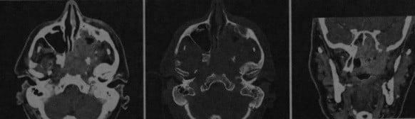 Снимки МРТ и КТ. Злокачественные эпителиальные опухоли