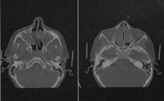 Снимки МРТ и КТ. Синусит, полипоз носа