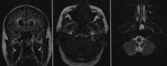 Снимки МРТ и КТ. Ретроназальный полип