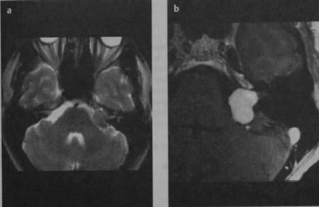 Снимки МРТ и КТ. Шваннома преддверно¬улиткового нерва