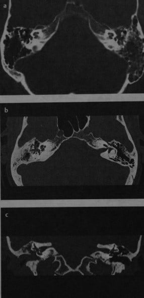 Снимки МРТ и КТ. Холестеатома пирамидки височной кости