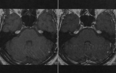 Снимки МРТ и КТ. Поражение лицевого нерва