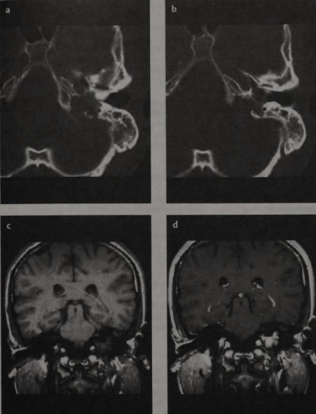 Снимки МРТ и КТ. Параганглиома, опухоль гломуса