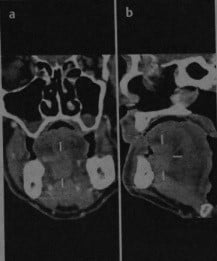 Снимки МРТ и КТ. Рак дна полости рта